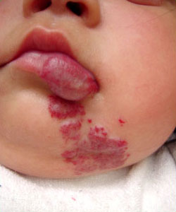 Hemangioma de la via aerea