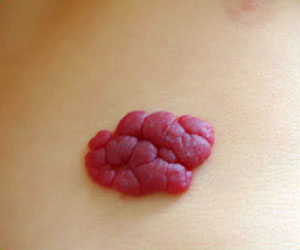 Hemangiomas Segmentarios