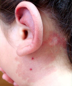 Fistulas Arteriovenosas