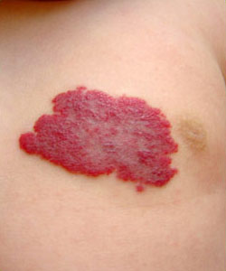 Hemangioma de la Infancia