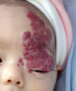 Hemangioma