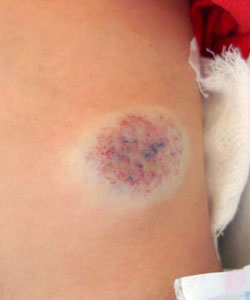 Hemangioma