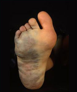 Malformacion Venosa 2