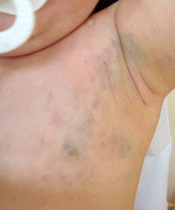 Malformacion Venosa 1